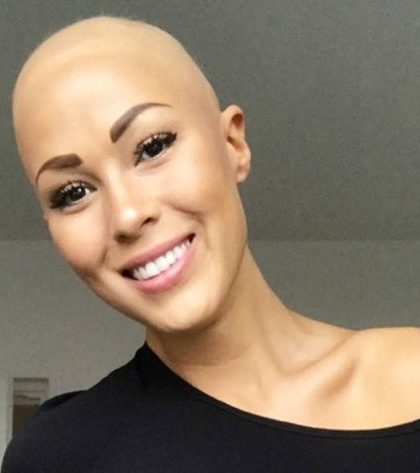 WOMAN WHO STRUGGLED TO ACCEPT HER ALOPECIA IS NOW Top MODEL