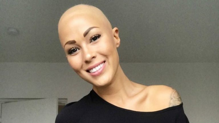 WOMAN WHO STRUGGLED TO ACCEPT HER ALOPECIA IS NOW Top MODEL